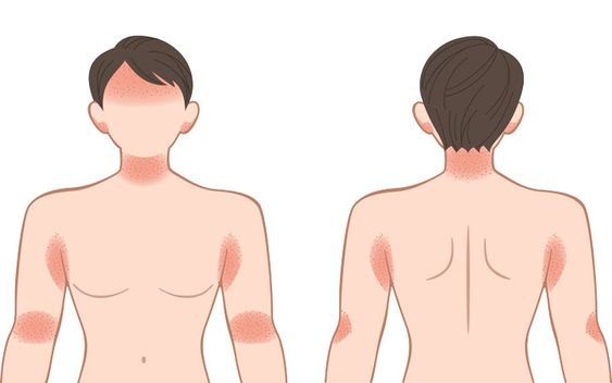 Eczema: Causes, Symptoms, and Treatment